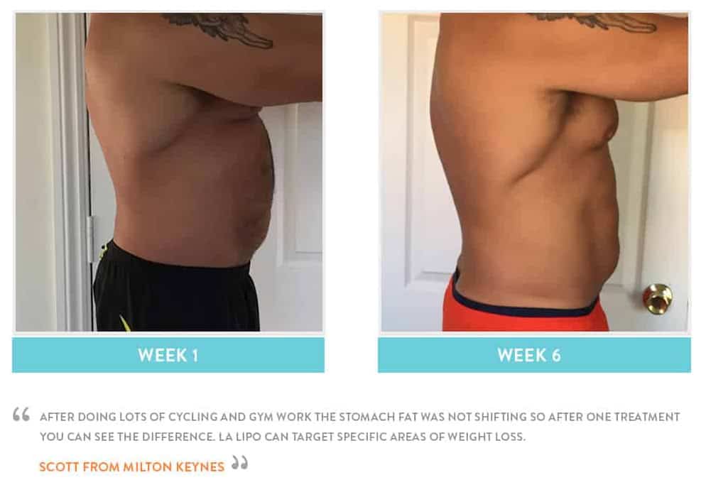 Before & After Stomach Fat Camberley