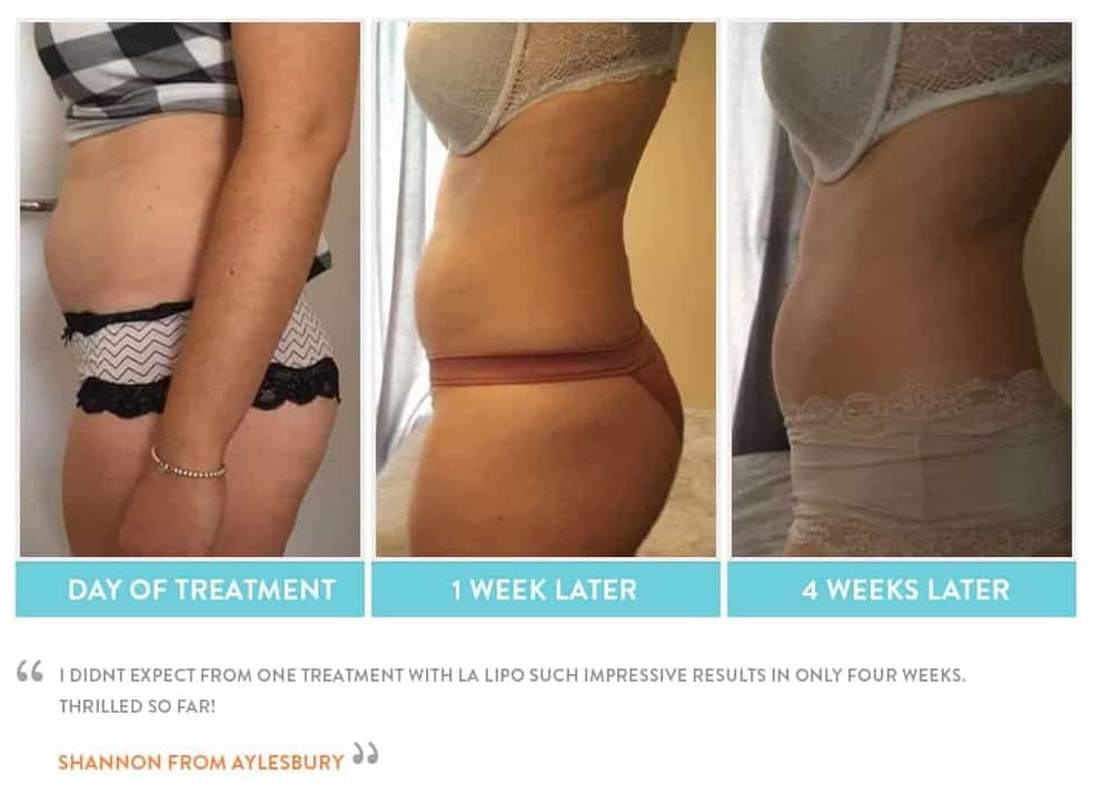 before, Cryolipolysis Camberley