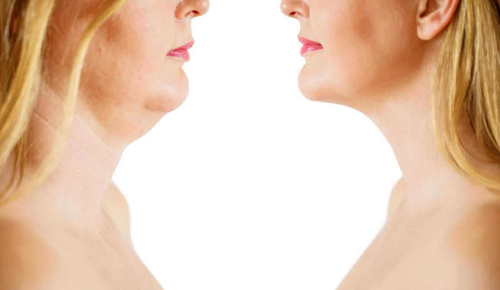 Double Chin treatment Camberley before and after results