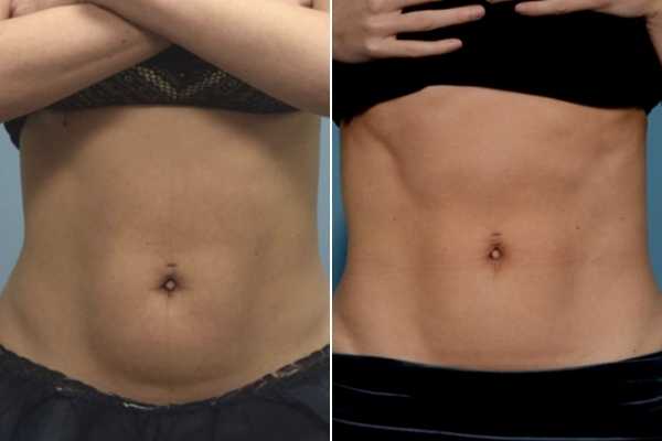 body sculpting FAQs Camberley