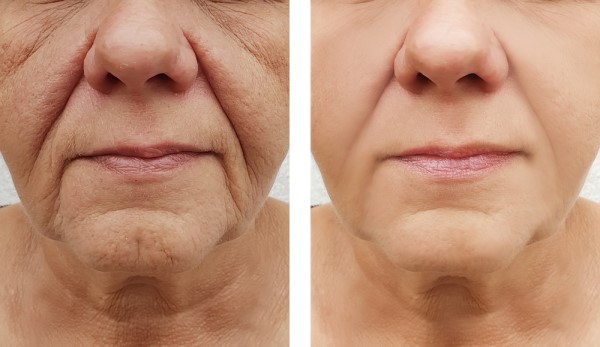 Learn more about Morpheus8 Treatment Camberley today!