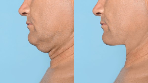 Which Non-Surgical Treatments Work Best for Jowls and Loose Skin Camberley?