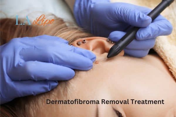Dermatofibroma Removal Treatment Camberley