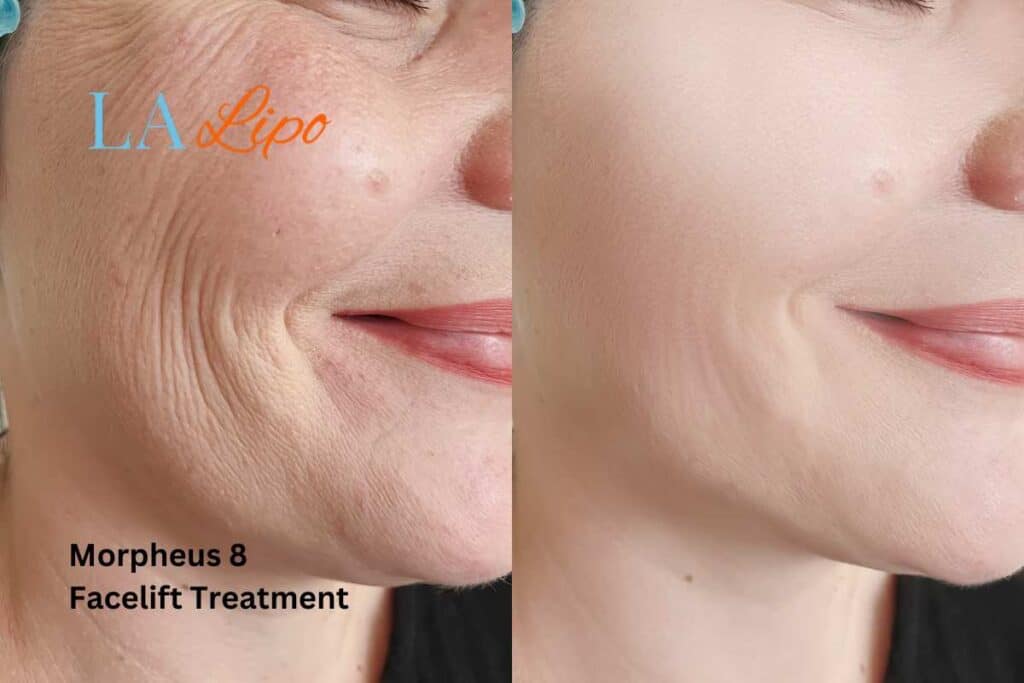 Morpheus8 Treatment Camberley for flawless skin! Call us today!