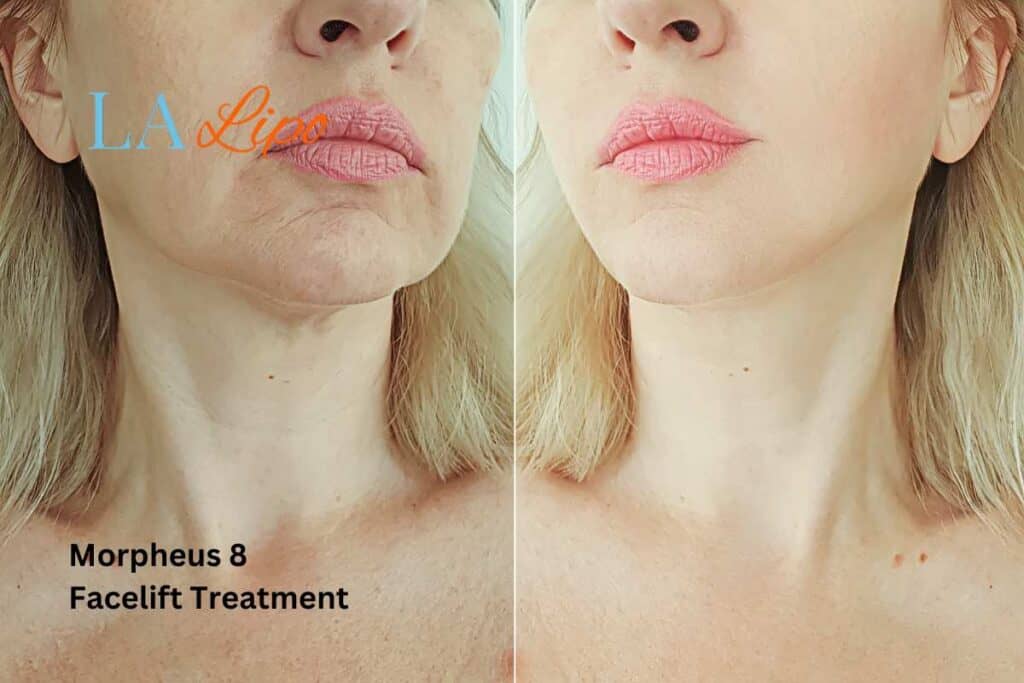 Turn back time with Morpheus8 Treatment Camberley