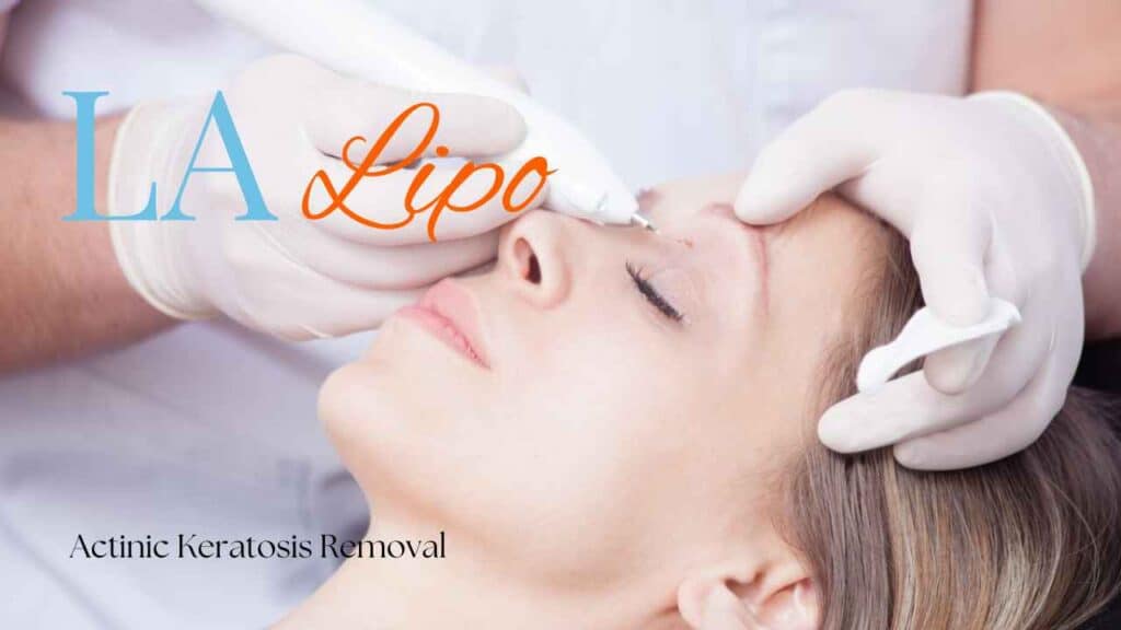 actinic keratosis removal Camberley