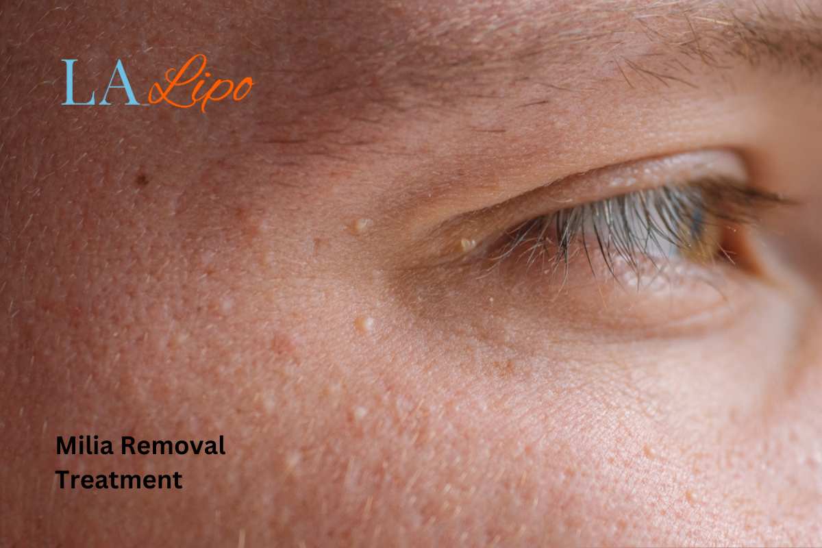 Cryopen Milia Removal: Is It the Easiest and Safest Option Camberley?