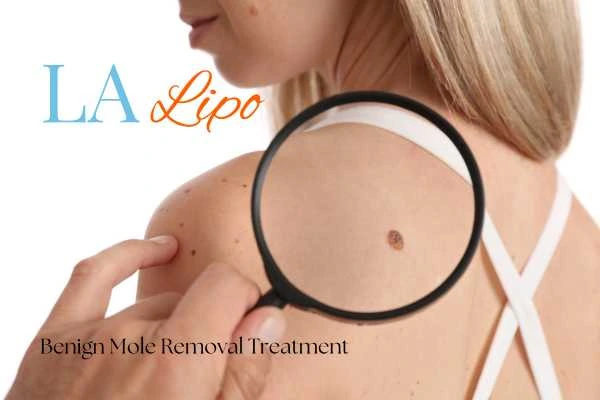 Woman having her inspection of blemish before mole removal Camberley