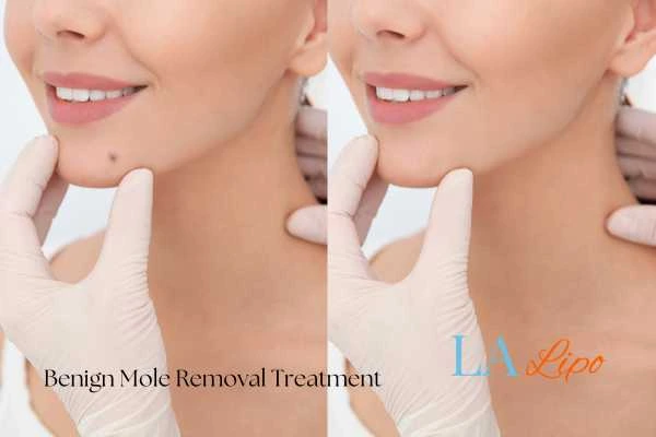 woman's before and after mole removal Camberley results