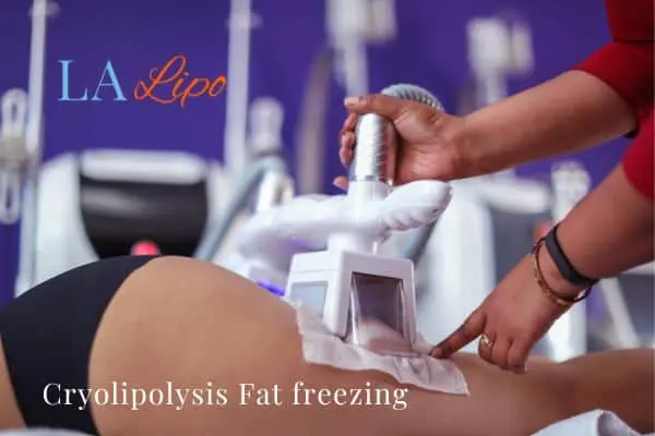 women getting fat freezing Camberley