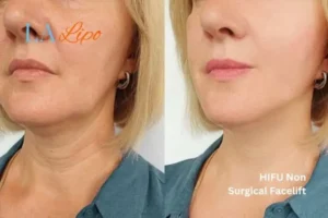 hi-fu for wrinkles Camberley before and after results