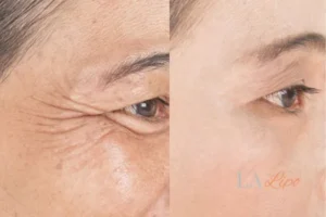 Before and after results of woman - HI-fu wrinkles reduction treatment Camberley