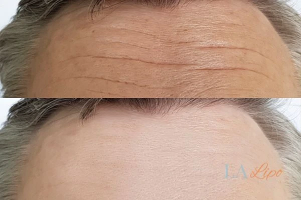 results of HIFU Camberley on mans forehead to help reduce lines and wrinkles