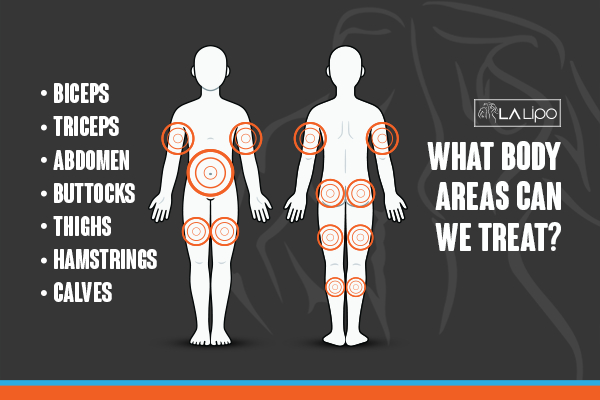 Graphic to show areas you can have LA-EMS Body Sculpting Camberley treatment.
