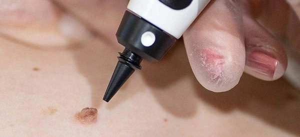 skin tag removal using cryopen Camberley