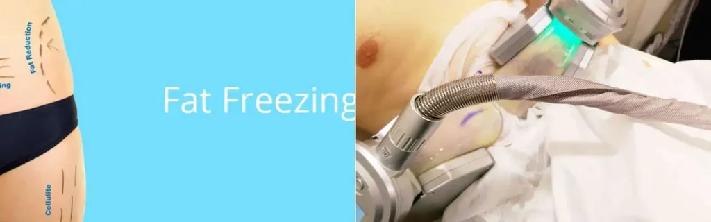 multi areas of a persons body having coolsculpting Camberley treatment