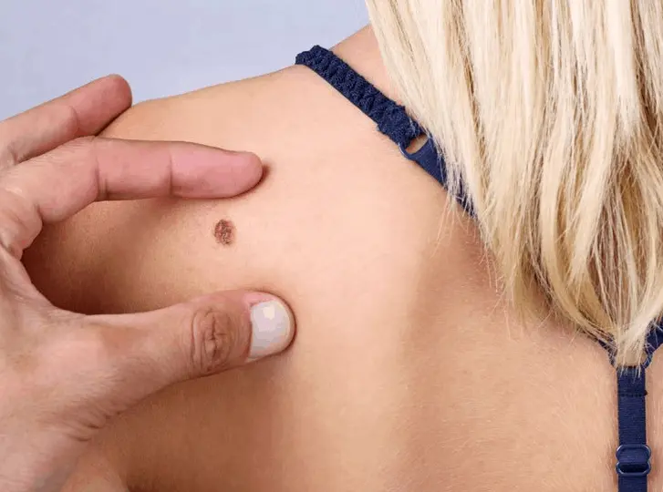 woman having mole removal Camberley consultation before treatment.