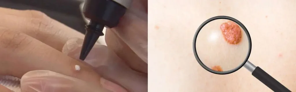 Cryopen for mole removal Camberley - speak to our team today!