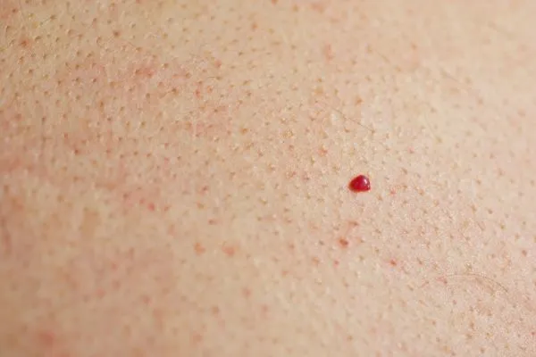 close up of a cherry angioma Camberley