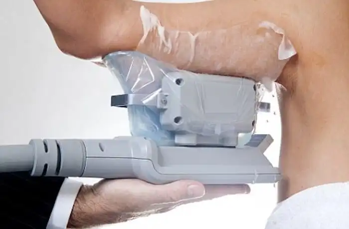 Picture of fat freezing Camberley on the upper arms.