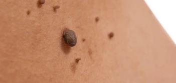 image of a skin tag Camberley