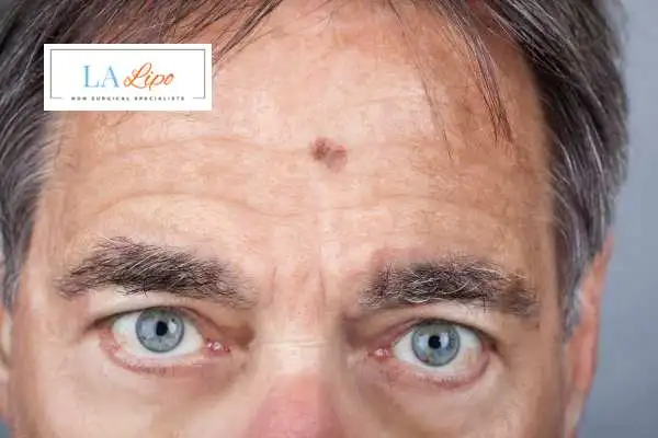 Solar Lentigo Removal Camberley image of man with mark on his forehead