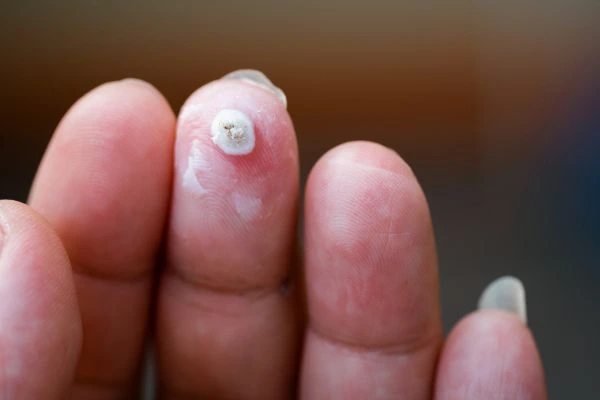 wart on person finger - cryotherapy to treat from LA LIPO Camberley