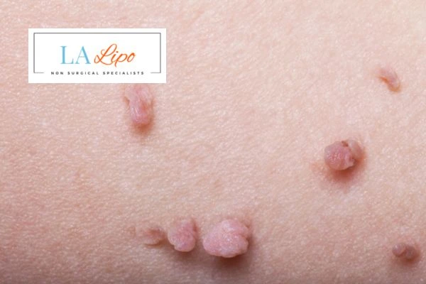 Does cryopen skin tag removal Camberley hurt? Find out now call our team today!