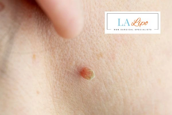 Book skin tag removal Camberley today speak to our team now!