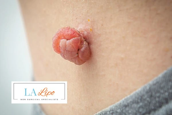 Interested in skin tag removal Camberley? Concerned about the pain? Find out more today!