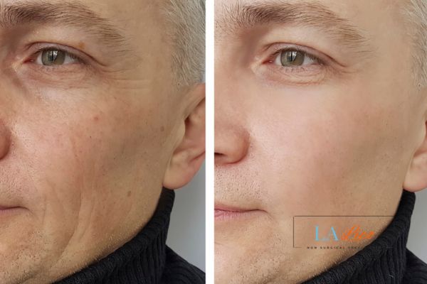 See the amazing results of Morpheus8 Treatment Camberley!