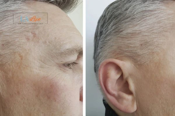 Mens Before & After Morpheus 8 Results Camberley