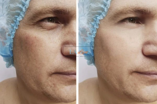 Before and after Morpheus 8 Results Camberley