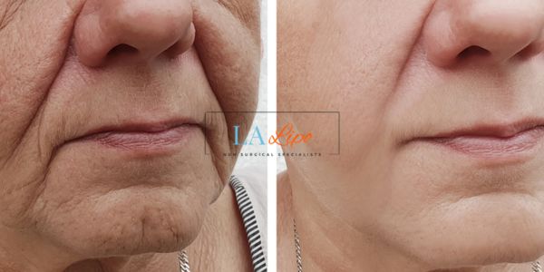Older lady deeper wrinkle reduction - LA LIPO Morpheus 8 Results Camberley