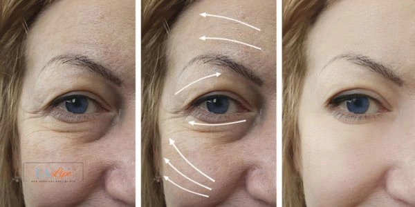 Amazing eye lift Morpheus 8 results Camberley