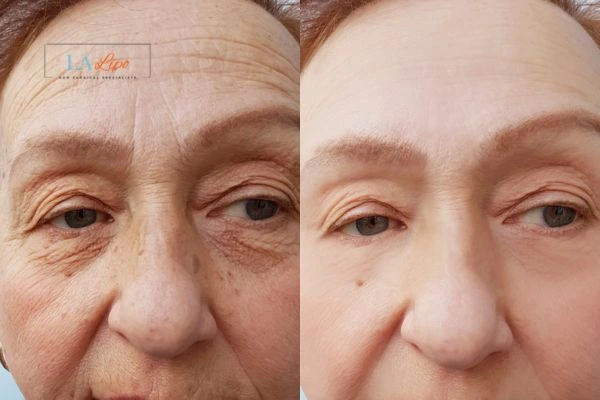 The powerful benefits of Morpheus8 Treatment Camberley - Call Our team today!