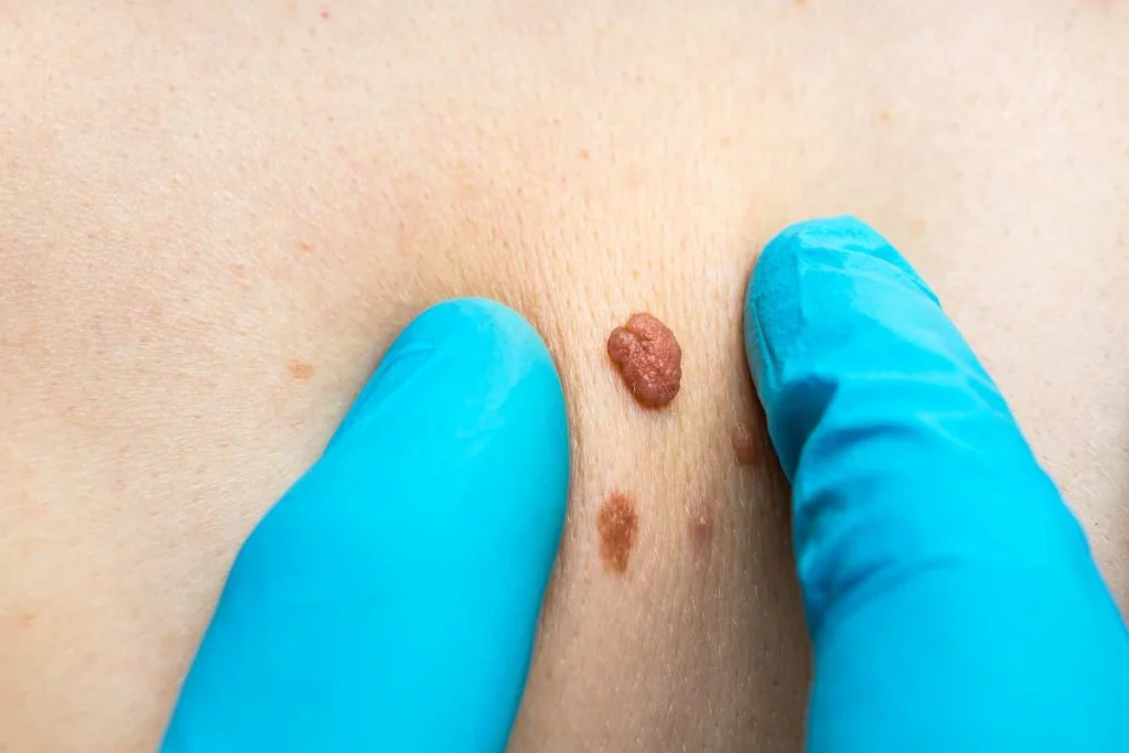 LA LIPO Cryopen Lesion Removal Prices Camberley