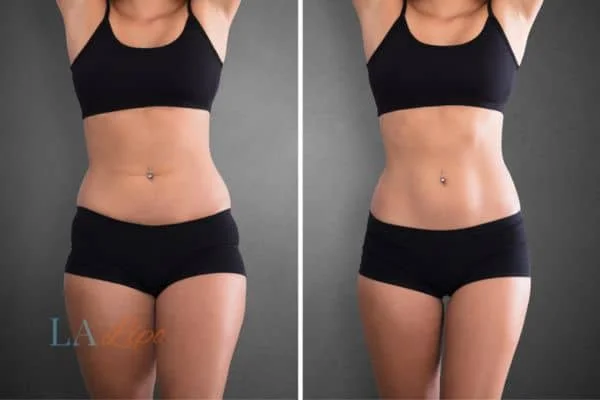 before and after results of non-surgical treatment to help a woman's body image and mental health Camberley