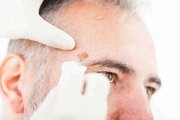 Age spots and elderly people Camberley what is the link?