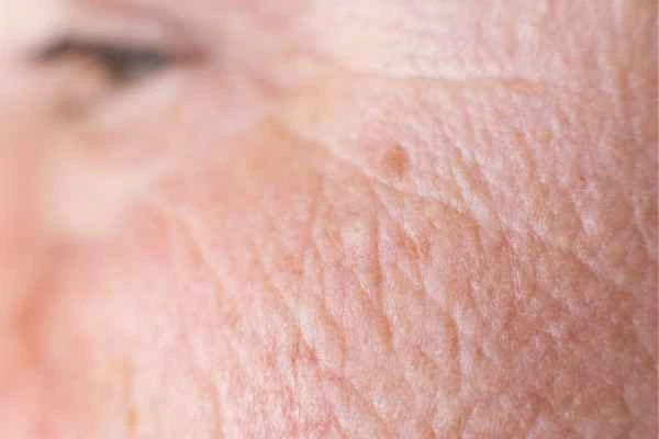 close up picture of a woman's face showing an age spot Camberley