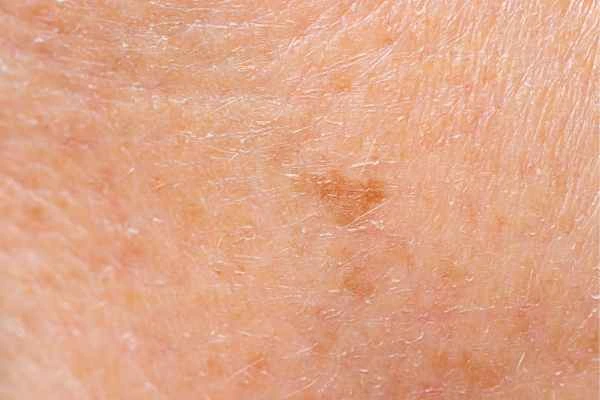 close up picture of age spots Camberley
