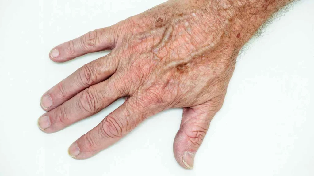 Male hand showing age spot Camberley