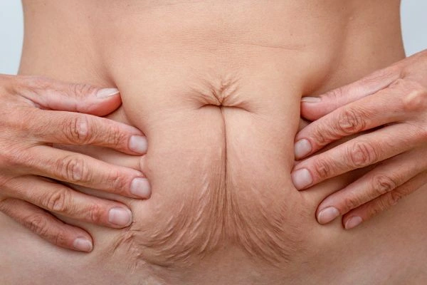 Image of a woman's stomach with loose skin - example of skin tightening Camberley options