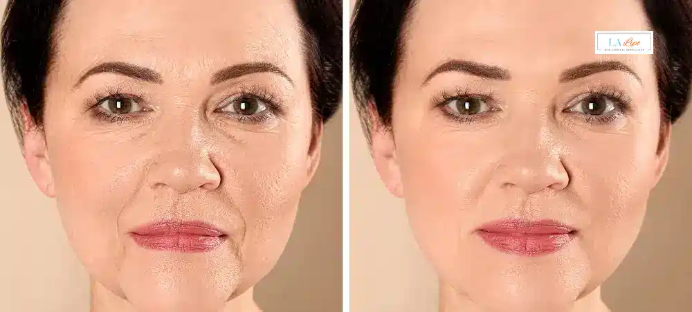 How Long Does It Take to See Results and How Long Do They Last Camberley?