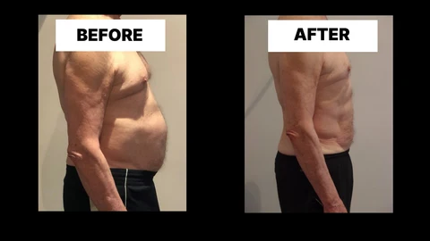 What Symptoms Can Diastasis Recti Cause in Men? Weak Core, Back Pain and Poor Posture Camberley